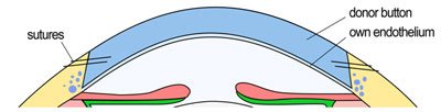 Lamellar Keratoplasty