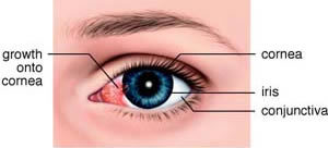 Pterygium disease eye