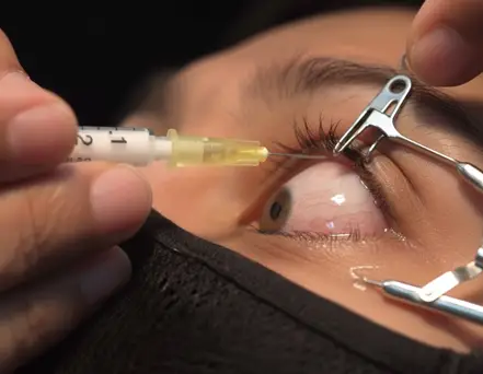 Intravitreal Injections