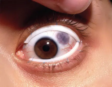 Scleral Buckling
