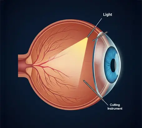 Vitrectomy surgery